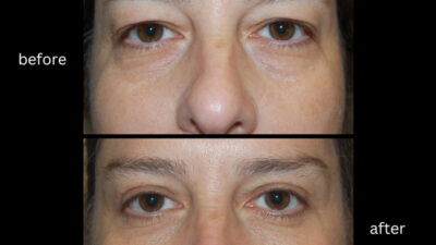 the-quiet-comeback-eye-bag-surgery-as-the-new-way-to-look-rested