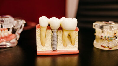 How to Choose the Right Dental Implant Provider