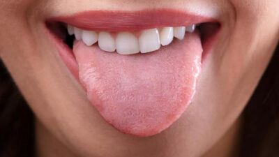 What Your Tongue Can Reveal About Oral Health