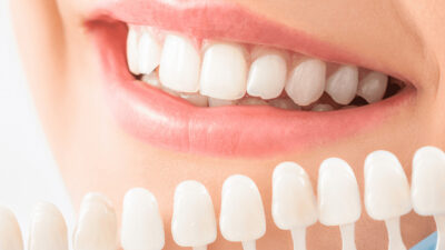 Temporary vs. Permanent Dental Crowns in Richardson – Whats the Difference