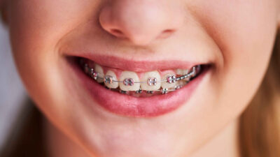 Finding the Right Options for Affordable Braces