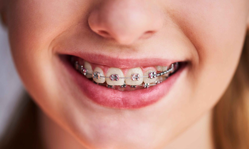 Finding the Right Options for Affordable Braces