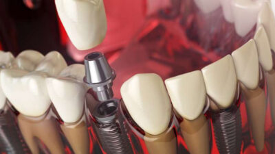 Innovative Tooth Replacement Solutions