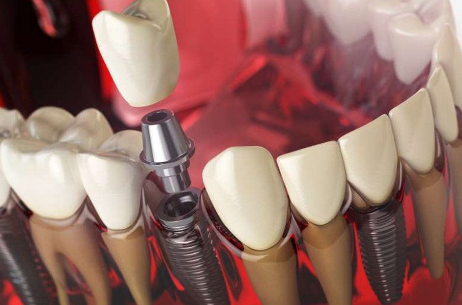 Innovative Tooth Replacement Solutions